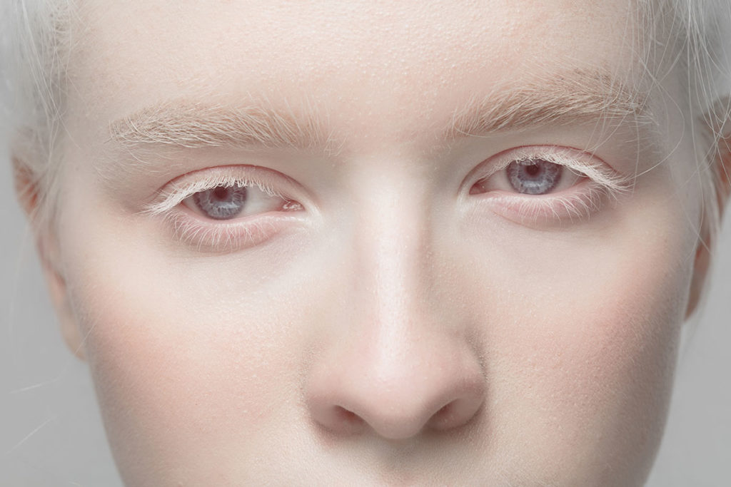 ALBINOS: Conoce la GENÉTICA y DESAFÍOS que Enfrentan 2 albinos conoce la genetica y desafios que enfrentan