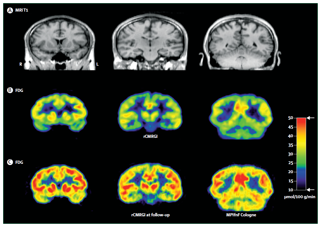 Amnesia Psicógena: SÍNTOMAS, CAUSAS y TRATAMIENTO EFECTIVO 2 amnesia psicogena sintomas causas y tratamiento efectivo