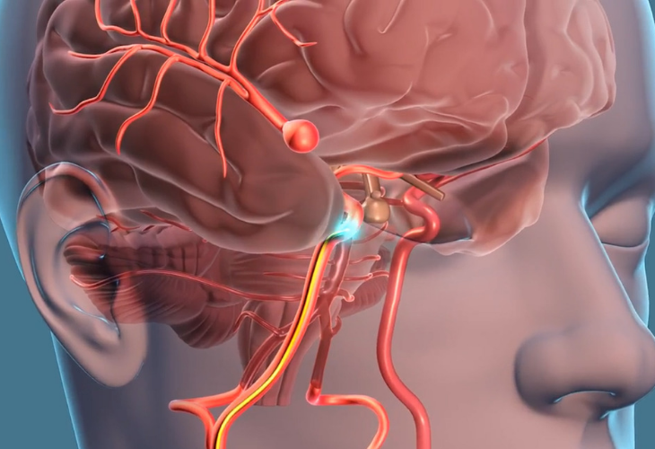 aneurisma cerebral significado causas y sintomas clave
