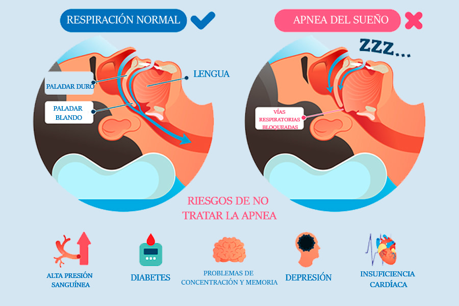 Apnea del Sueño: Descubre Tipos y Tratamientos Esenciales 2 apnea del sueno descubre tipos y tratamientos esenciales