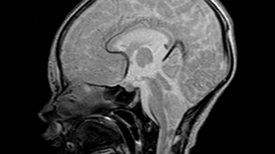 arnold chiari sintomas y tipos terapia en madrid
