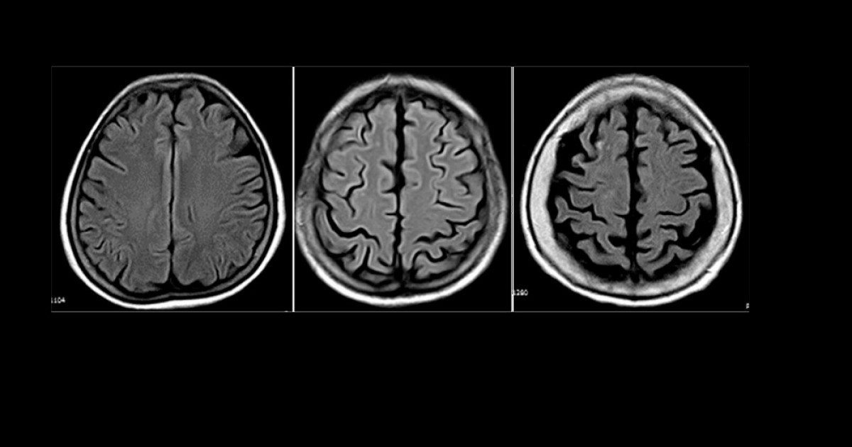 Atrofia CORTICAL: Síntomas, CAUSAS y Trastornos ASOCIADOS 6 atrofia cortical sintomas causas y trastornos asociados