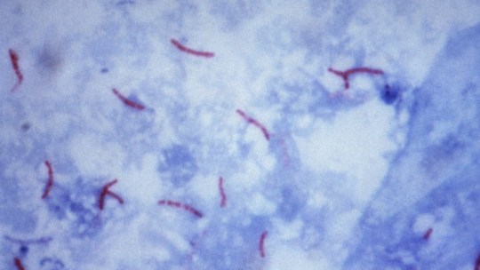 BACILOSCOPIA: Qué es y Cómo se Realiza - Salud en MADRID 2 baciloscopia que es y como se realiza salud en madrid
