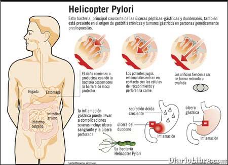 Bacteria PYLORI: Conoce los DAÑOS y Sintomas en el ESTÓMAGO 2 bacteria pylori conoce los danos y sintomas en el estomago