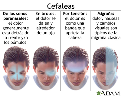 causas y soluciones para el dolor de cabeza por tension