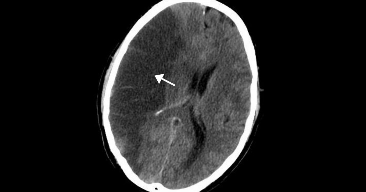 CEREBRAL ISCHEMIA: SÍNTOMAS, CAUSAS y TRATAMIENTO en MADRID 2 cerebral ischemia sintomas causas y tratamiento en madrid