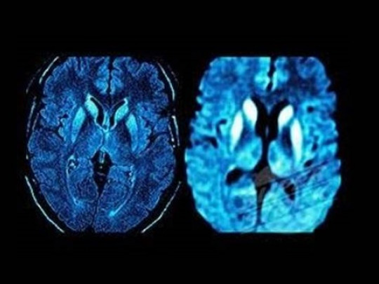 CEREBRO HUMANO: CARACTERÍSTICAS y PATOLOGÍAS REVELADORAS 2 cerebro humano caracteristicas y patologias reveladoras