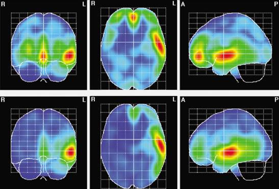 cerebro masculino vs femenino diferencias clave en madrid