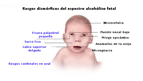 Cómo Identificar el Síndrome Alcohólico Fetal en Madrid 2 como identificar el sindrome alcoholico fetal en madrid