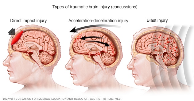 conmocion cerebral sintomas causas y tratamientos clave
