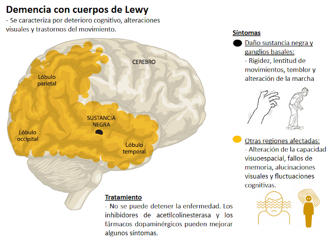 cuerpo de lewy sintomas y tratamientos que debes conocer