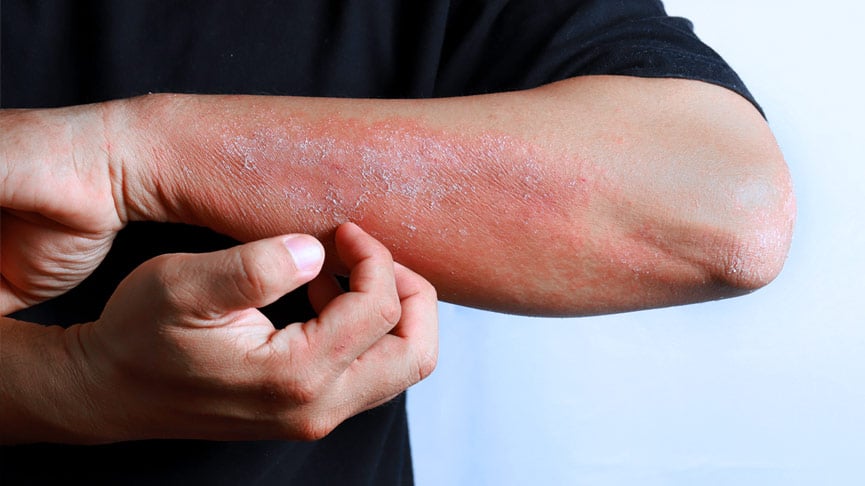 dermatitis por estres tipos y como tratarla facilmente