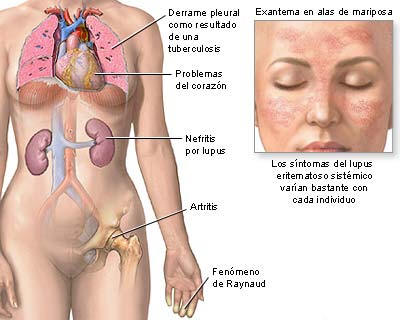 Descubre los Síntomas del Lupus Eritematoso en Madrid 2 descubre los sintomas del lupus eritematoso en madrid