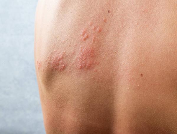 descubre los tipos de herpesvirus y sus enfermedades