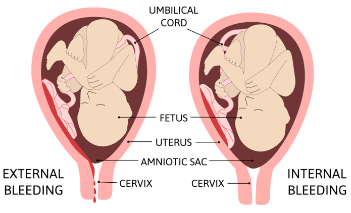 Descubre Tipos de Aborto y sus Efectos en Terapia Online 2 descubre tipos de aborto y sus efectos en terapia online
