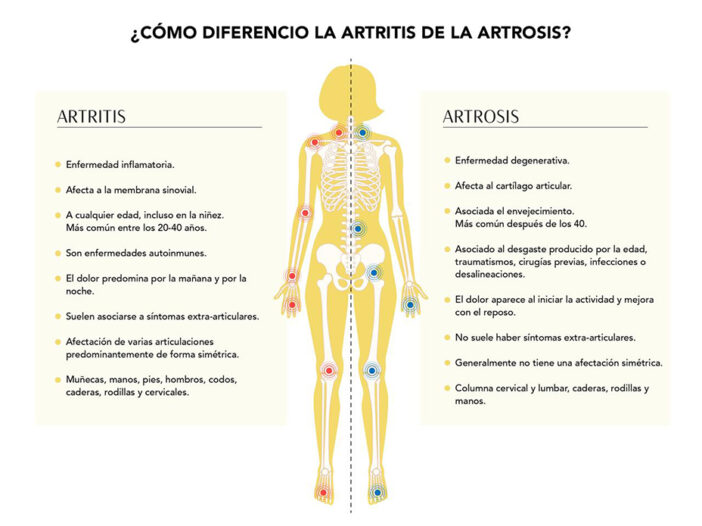 DOLOR DE ARTICULACIONES: Causas y SOLUCIONES en Madrid 2 dolor de articulaciones causas y soluciones en madrid