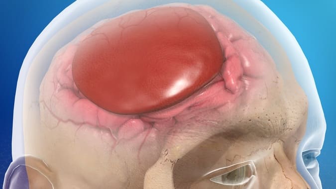 e296b7 muerte cerebral causas sintomas y se puede despertar