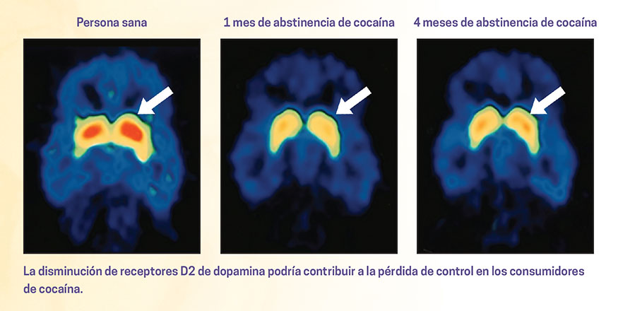 Efectos del CRACK: Consecuencias de la ADICCIÓN y SOLUCIONES 2 efectos del crack consecuencias de la adiccion y soluciones