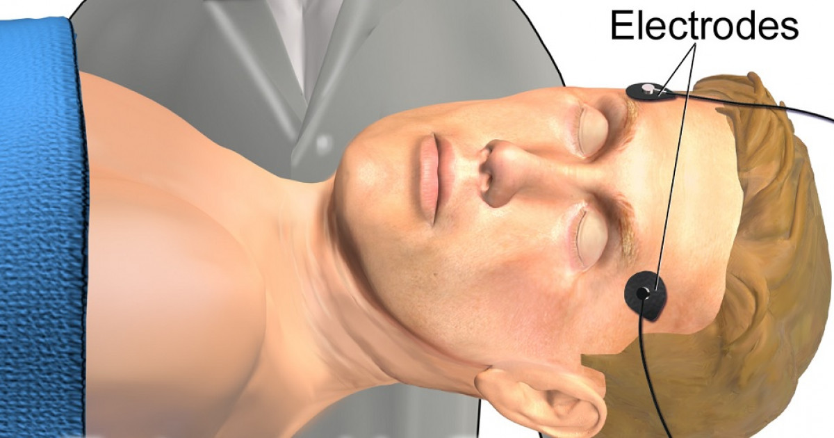Electroconvulsiva: Usos y BENEFICIOS en TERAPIAS ONLINE 2 electroconvulsiva usos y beneficios en terapias online