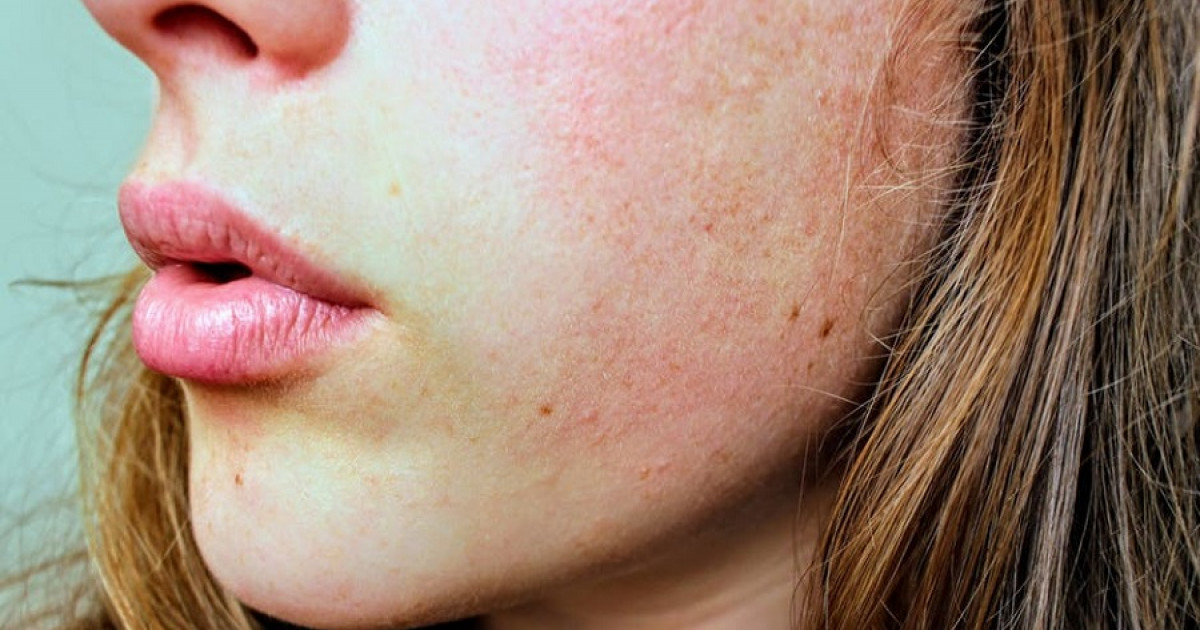 Elimina las cicatrices del acné rápido: 8 consejos efectivos 2 elimina las cicatrices del acne rapido 8 consejos efectivos