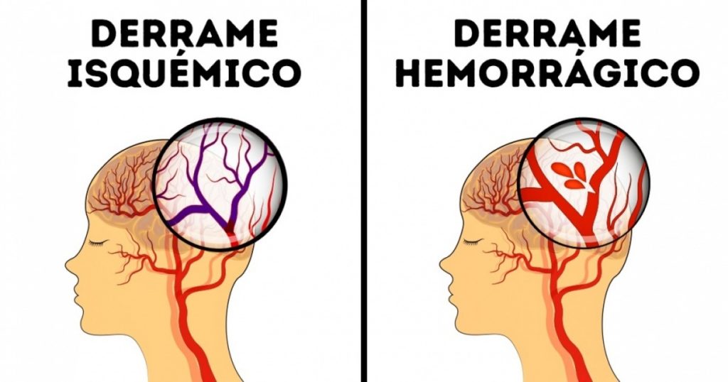 EMBOLIA CEREBRAL: TIPOS, SÍNTOMAS y CAUSAS que DEBES CONOCER 2 embolia cerebral tipos sintomas y causas que debes conocer