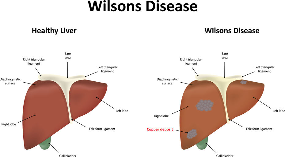 enfermedad de wilson diagnostico y tratamiento en madrid