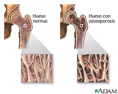 Enfermedades en los HUESOS: Descubre las 4 MÁS IMPORTANTES 2 enfermedades en los huesos descubre las 4 mas importantes