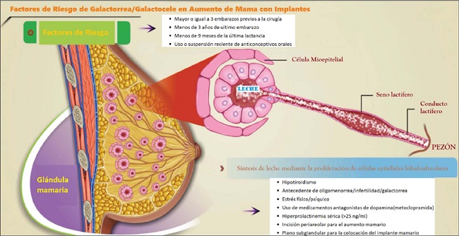 GALACTORREA: Causas, SÍNTOMAS y TRATAMIENTO en Madrid 2 galactorrea causas sintomas y tratamiento en madrid