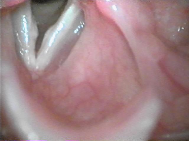 Glottis: Descubre su Papel Clave en tu Salud y Bienestar 2 glottis descubre su papel clave en tu salud y bienestar