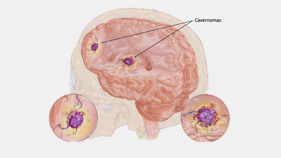 HAEMANGIOMA CEREBRAL: DIAGNÓSTICO y TRATAMIENTO en MADRID 2 haemangioma cerebral diagnostico y tratamiento en madrid
