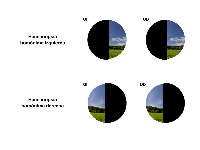 HEMIANOPSIA: TIPOS, SÍNTOMAS y TRATAMIENTO ESENCIAL 2 hemianopsia tipos sintomas y tratamiento esencial