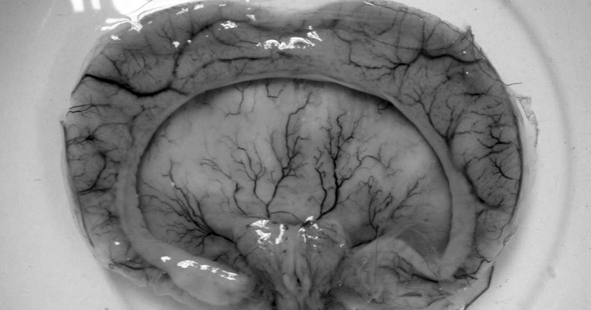 holprosencefalia semilobar diagnostico y tratamiento efectivo