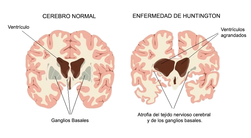 HUNTINGTON'S CHOREA: DIAGNÓSTICO y TRATAMIENTO EN MADRID 2 huntingtons chorea diagnostico y tratamiento en madrid