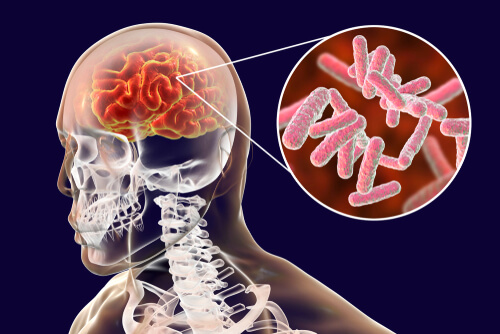 infecciones cerebrales clasificacion y sintomas esenciales