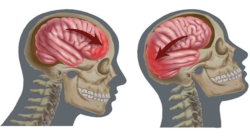 inflamacion del cerebelo diagnostico y tratamiento efectivo