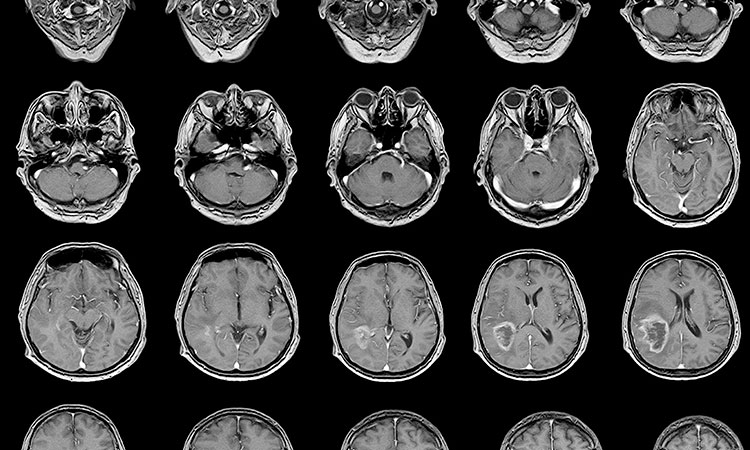 isquemia cerebral sintomas causas y tratamiento efectivo