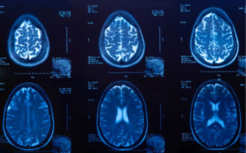 LÍQUIDO EN EL CEREBRO: TIPOS de HIDROCEFALIA y Tratamientos 24 liquido en el cerebro tipos de hidrocefalia y tratamientos