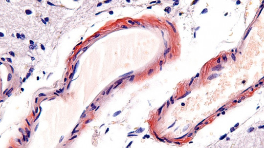 Microangiopatía: Diagnóstico y Tratamiento en Madrid 2 microangiopatia diagnostico y tratamiento en madrid