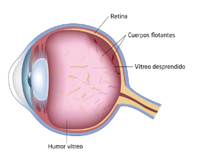 Miodesopsias: Tratamiento para MOSCAS VOLANTES por ESTRÉS 2 miodesopsias tratamiento para moscas volantes por estres