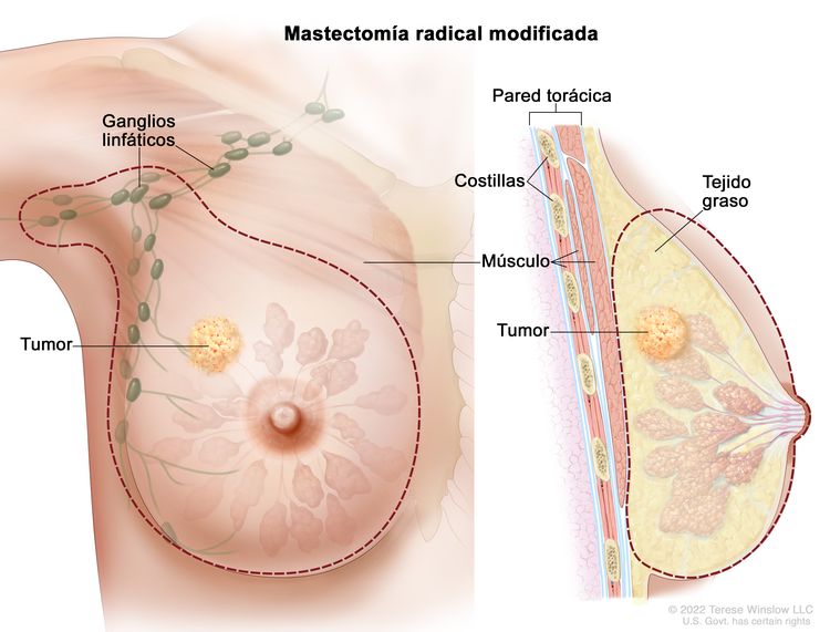 Neoplasia: Descubre Tipos, Síntomas y Tratamientos Efectivos 2 neoplasia descubre tipos sintomas y tratamientos efectivos