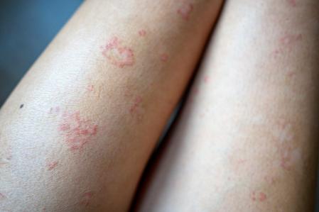 Neurodermatitis: Tratamientos Efectivos que No Sabías 2 neurodermatitis tratamientos efectivos que no sabias