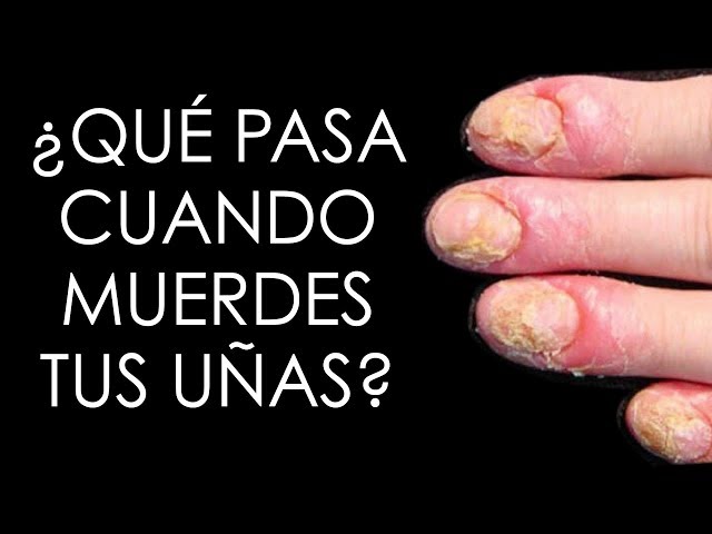 ONICOFAGIA: Qué es y Cómo SUPERAR el HÁBIT de Morder Uñas 2 onicofagia que es y como superar el habit de morder unas