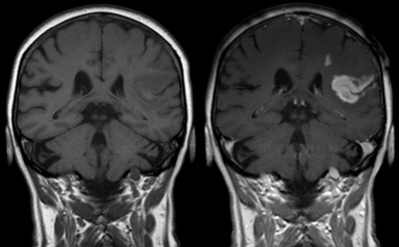 paragramatismo sintomas causas y tratamientos efectivos