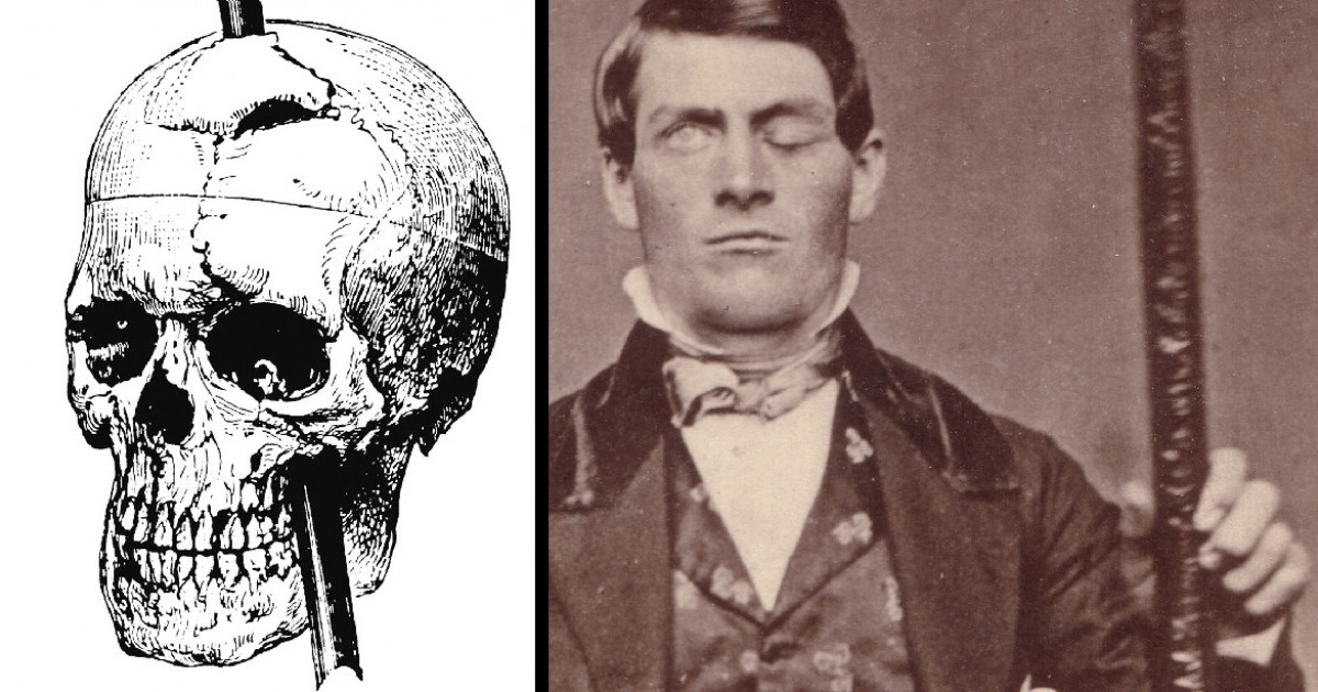 PHINEAS GAGE: El INCREÍBLE caso de la BARRA de METAL 2 phineas gage el increible caso de la barra de metal