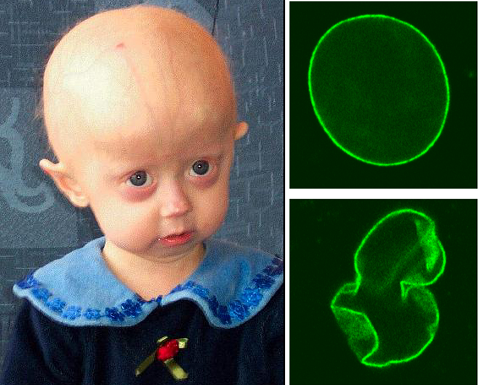 progeria descubre causas sintomas y tratamientos eficaces