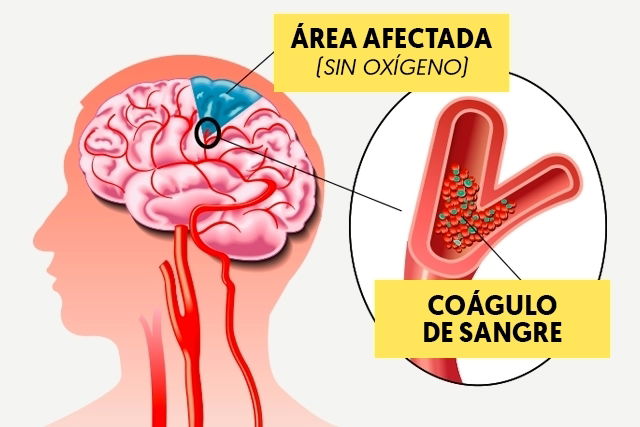 SANGRE EN EL CEREBRO: CONSECUENCIAS y Tratamientos Efectivos 38 sangre en el cerebro consecuencias y tratamientos efectivos