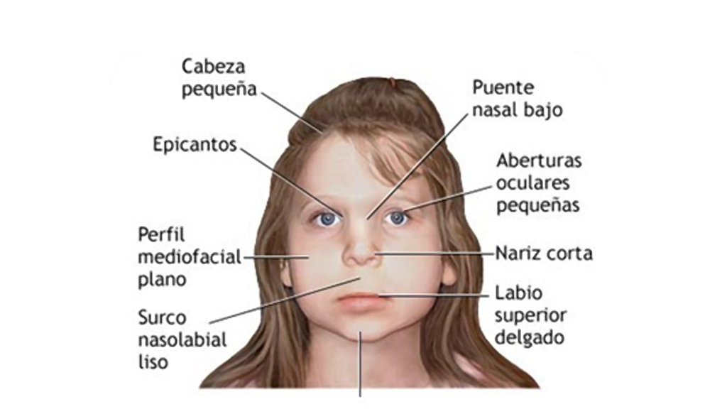 sindrome de angelman diagnostico y tratamiento en madrid