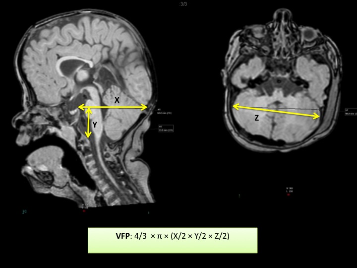 Síndrome de Crouzon: Diagnóstico y Tratamiento en Madrid 2 sindrome de crouzon diagnostico y tratamiento en madrid