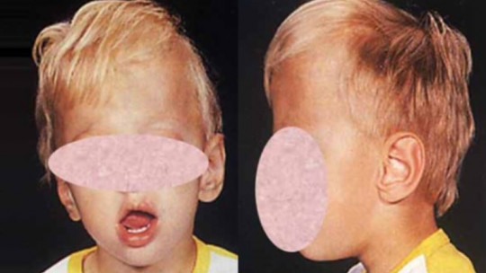 Síndrome de Gerstmann: Diagnóstico y Tratamiento en Madrid 2 sindrome de gerstmann diagnostico y tratamiento en madrid