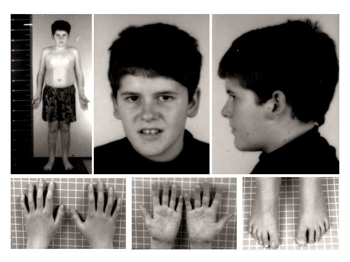 Síndrome de Prader-Willi: Descubre Síntomas y Tratamientos 2 sindrome de prader willi descubre sintomas y tratamientos